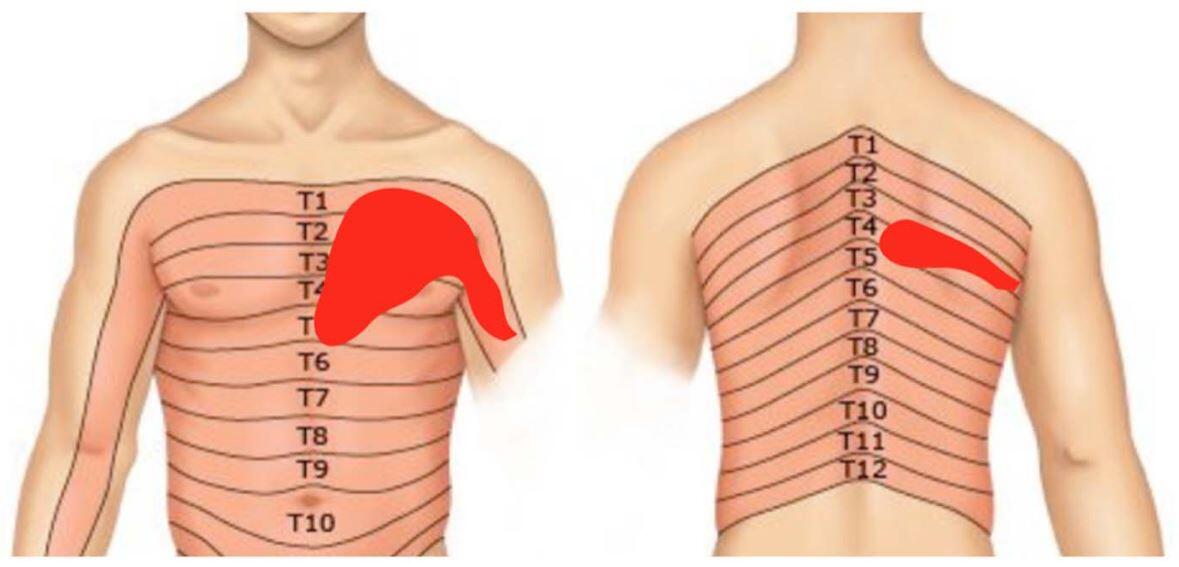 Dermatom Nedir? Vücudun Dermatom Haritası torakal dermatomlar