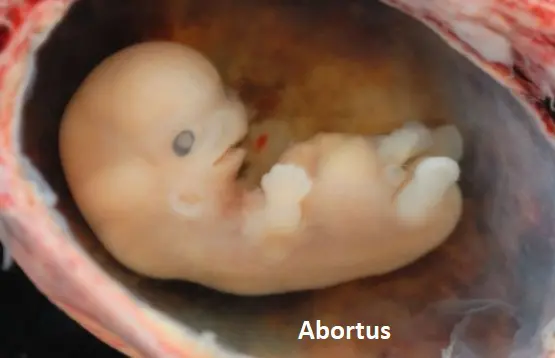 tıpta abortus ne demek