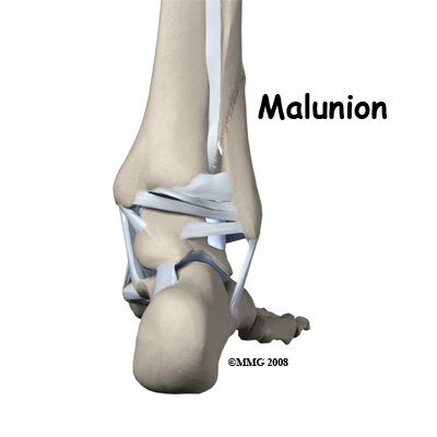 malunion ne demektir