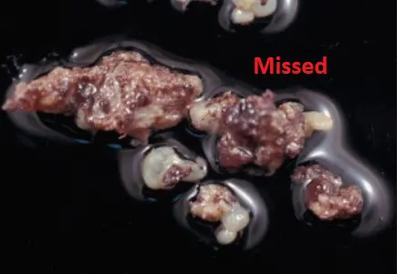 missed abortus nedir