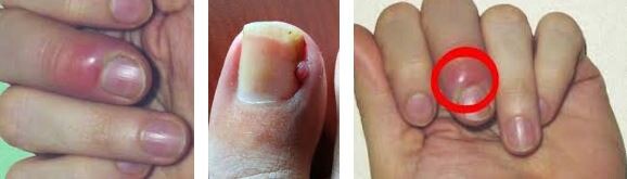 Paronişi (Dolama) Nedir? paronisi nedir