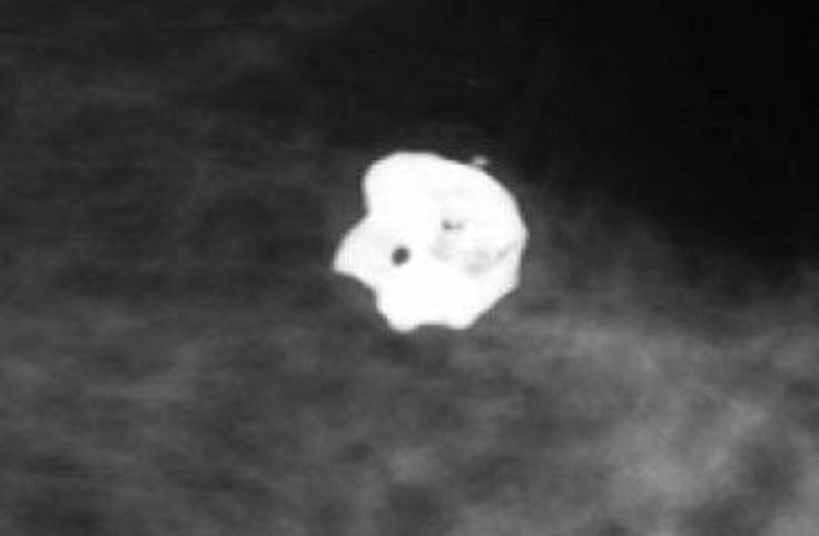 meme kalsifikasyonlari nedir