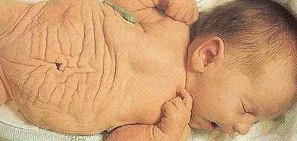 prune belly sendromu nedir