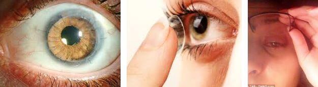 Akantomoeba Keratiti Nedir? Belirtileri ve Tedavisi