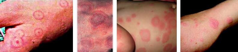 eritema multiforme belirtileri