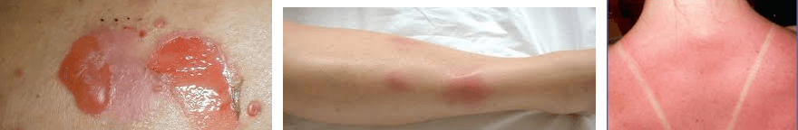 eritema multiforme bulasici mi