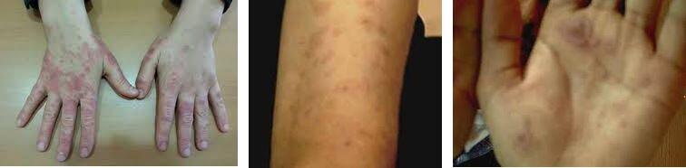 eritema multiforme minor