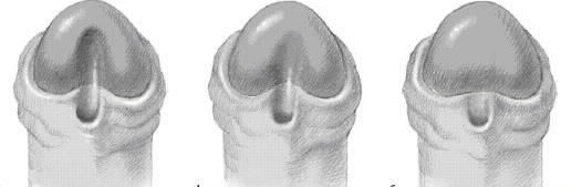 Hipospadias: Peygamber Sünneti