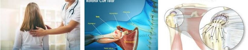 Rotator Cuff Sendromu rotator cuff sendromu