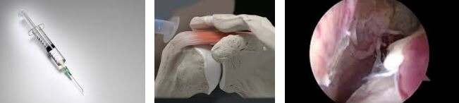 Rotator Cuff Sendromu rotator cuff zedelenmesi