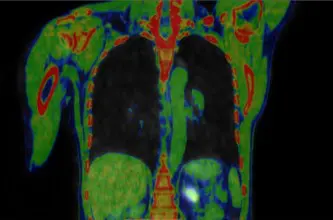 fdg tutulumu pet taraması