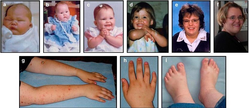 smith magenis sendromu nedir ve tedavisi