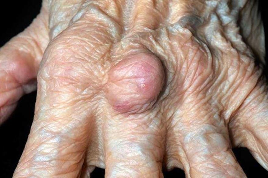 felty sendromu nedenleri