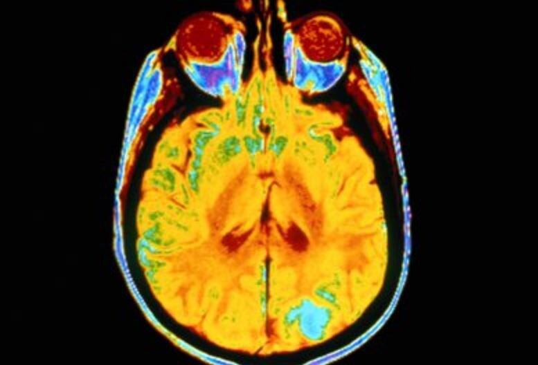 glioblastoma multiforme nedenleri