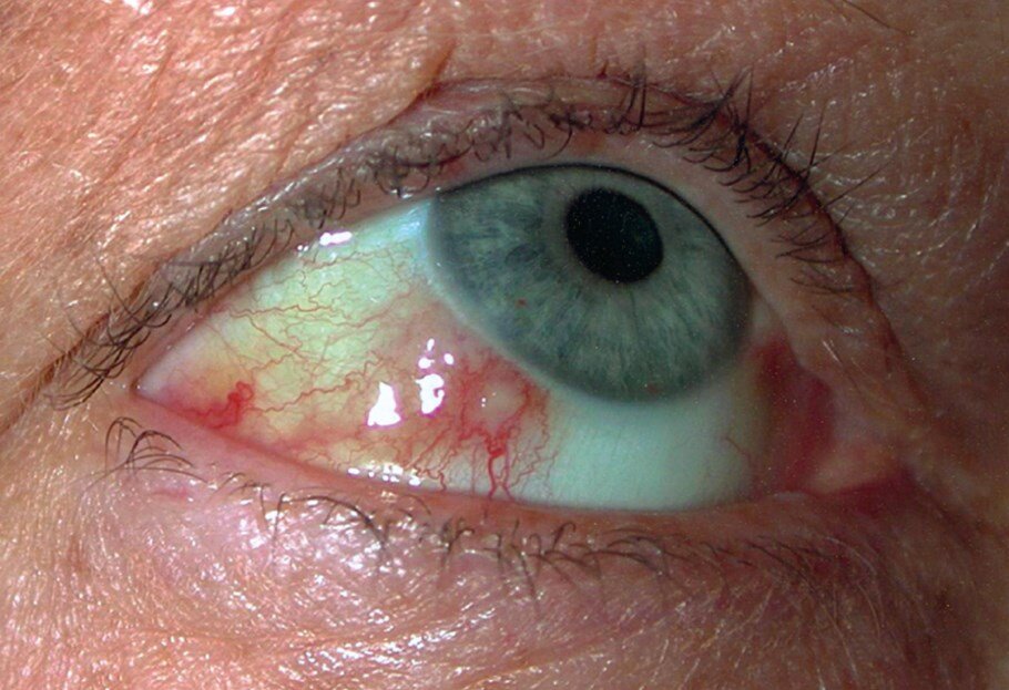 churg strauss sendromu nedenleri