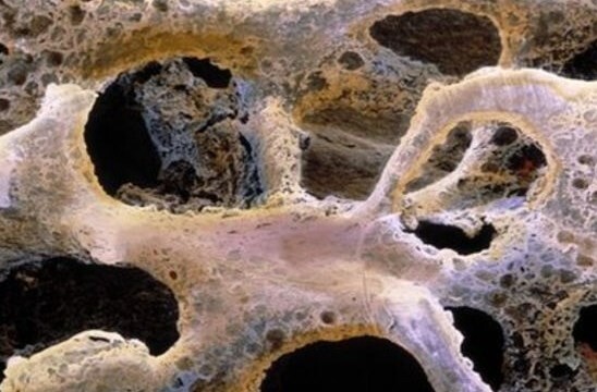 osteogenezis imperfekta nedenleri