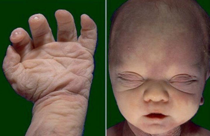 potter sedromu nedenleri