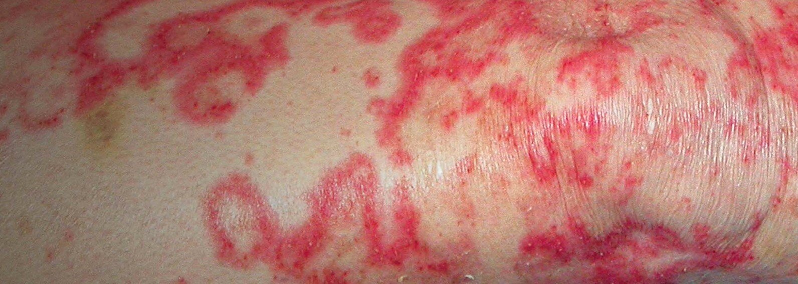 cilt hastaliklari icin hangi doktora gidilir