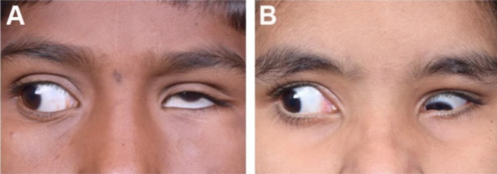 duane sendromu şaşılık