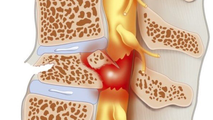 spinal kord yaralanmasi