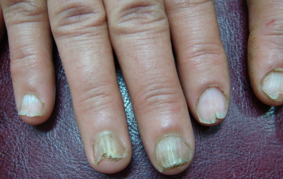 tirnak batmasina hangi bolum bakar