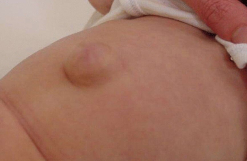 fıtık hastaligina hangi bolum bakar