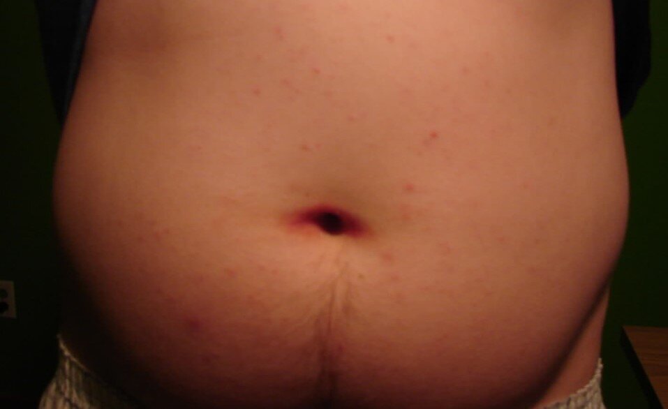 Gobek Deligi Iltihabi Icin Hangi Bolume Gidilir Dr Erhan Yavuz