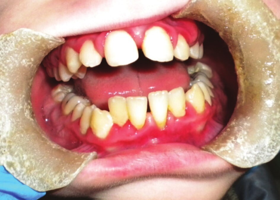 papillon lefevre sendromu