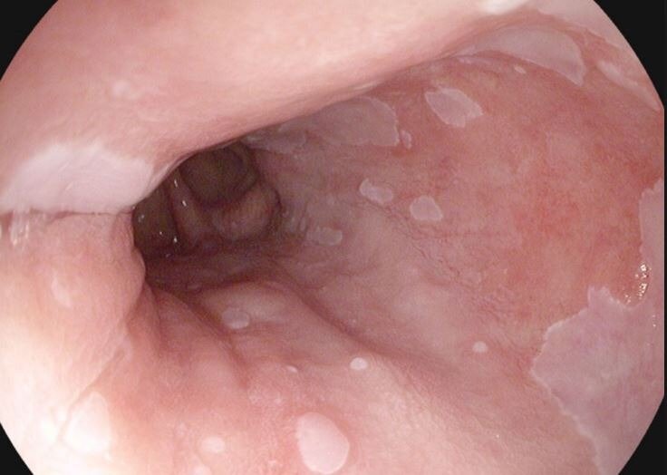 endoskopik biyopsi neden ve nasil yapilir