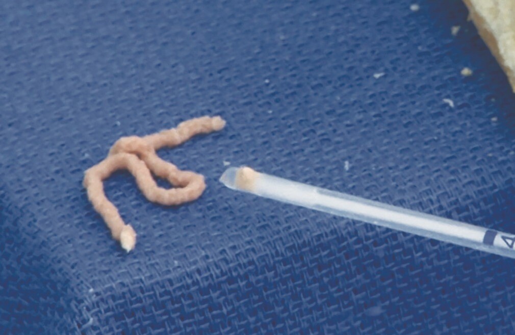 pipelle biyopsi ne demektir