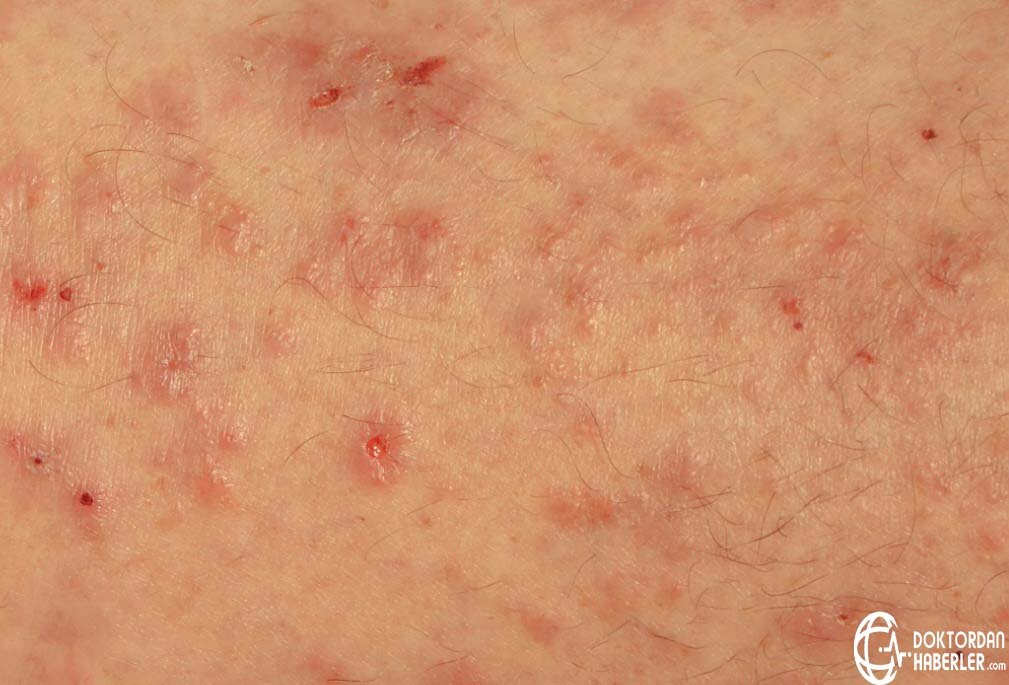 apis arasinda kasinti