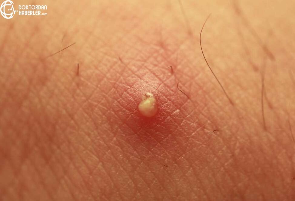 testiste sivilce testiste sivilce