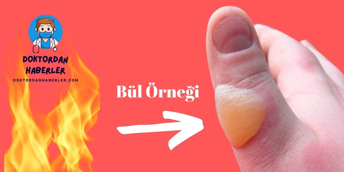 Yanıktan Sonra Su Toplaması Neden Olur? yanıktan sonra neden bül oluşur