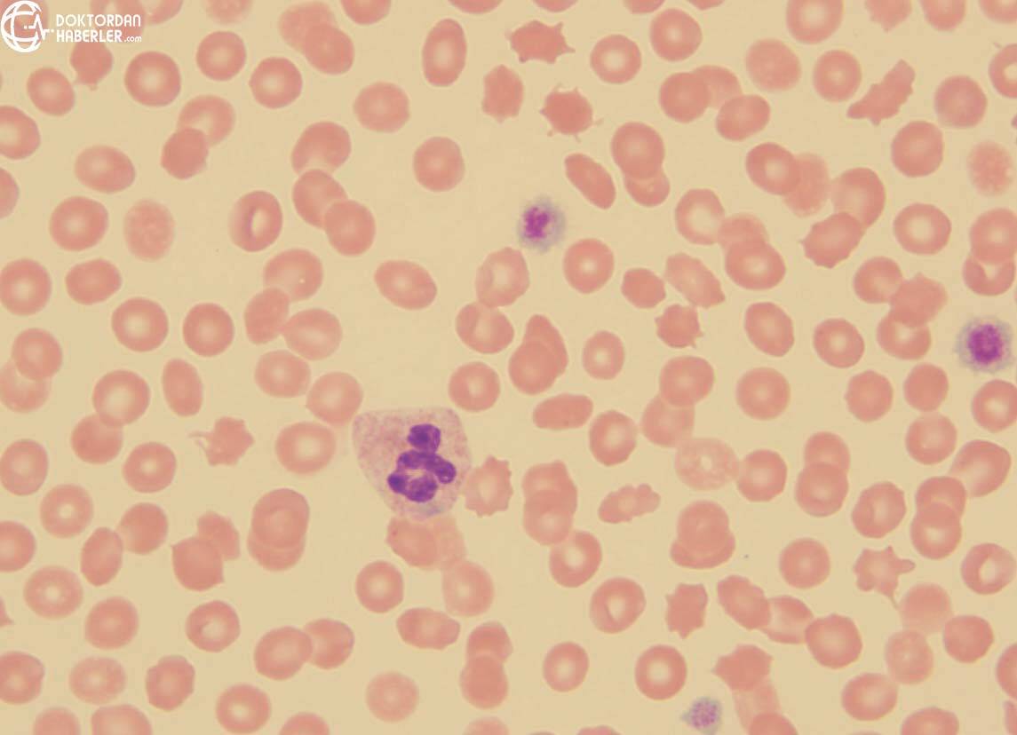 bernard soulier sendromu tedavisi