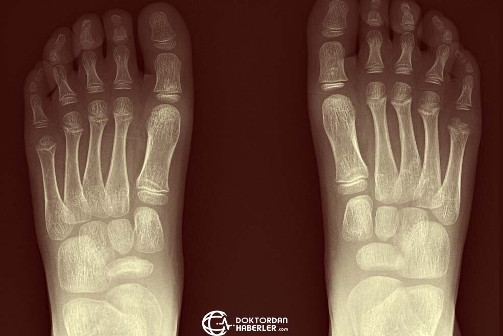 kohler hastaligi nedir