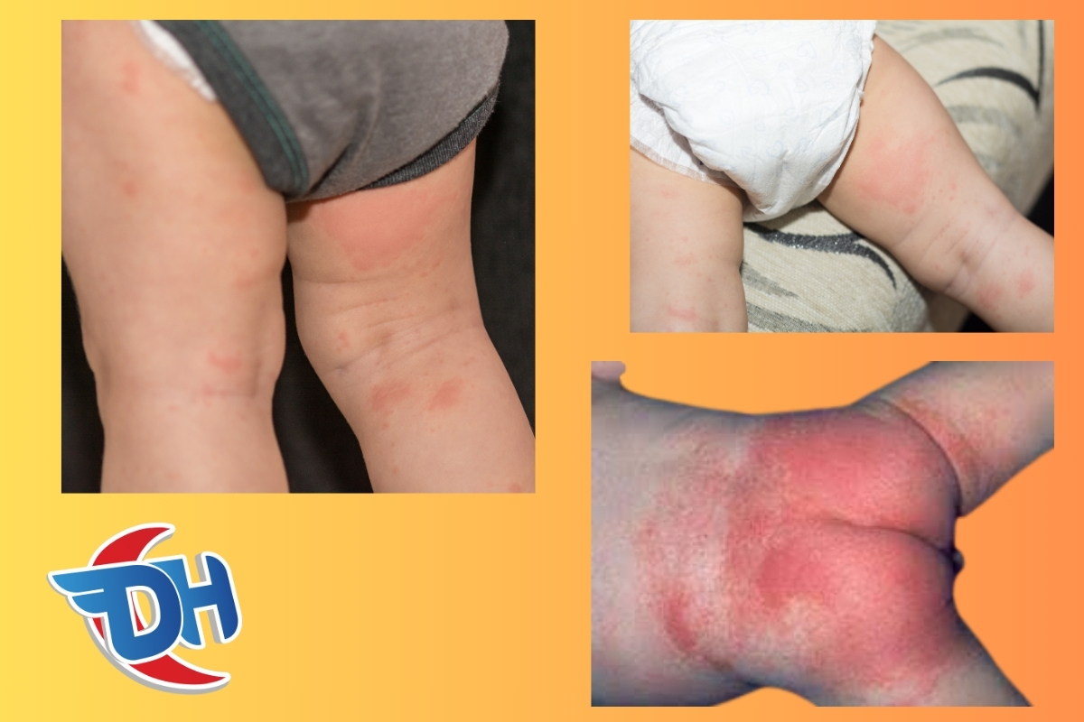 Pişik Tedavisi için Hangi Doktora Gidilmeli? pişik için hangi bölüme gidilir