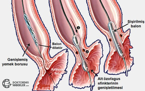 Dilatasyon Tıp Dilinde Nedir? dilatasyon nedir