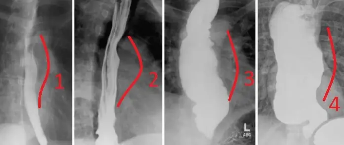 Dilatasyon Tıp Dilinde Nedir? özafagus dilatasyonu
