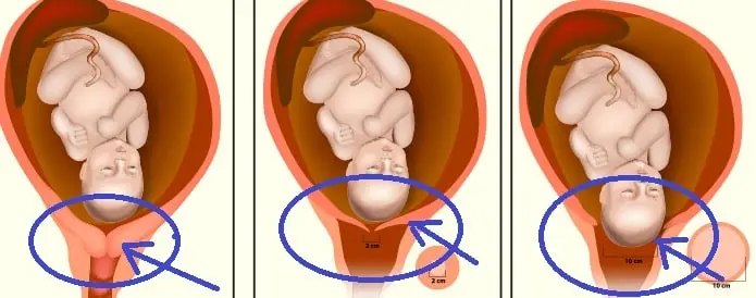 Dilatasyon Tıp Dilinde Nedir? serviks dilatasyonu