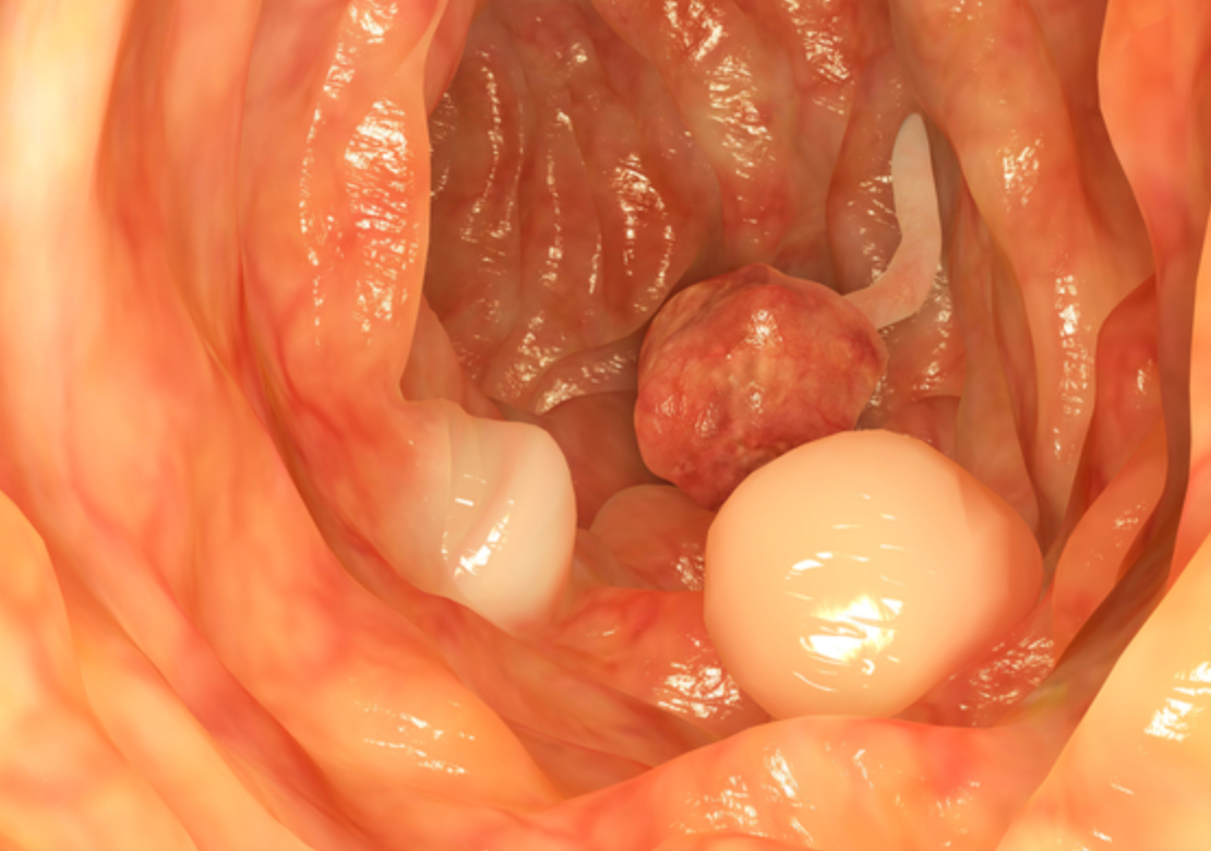 lynch sendromu nedir