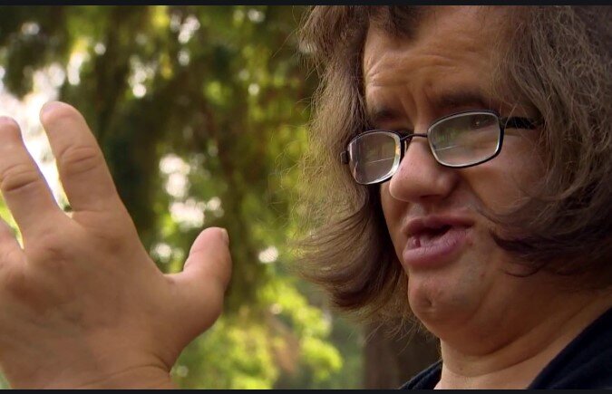 coffin siris hastaligi tedavisi