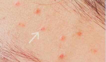 mekanik akne ne demek