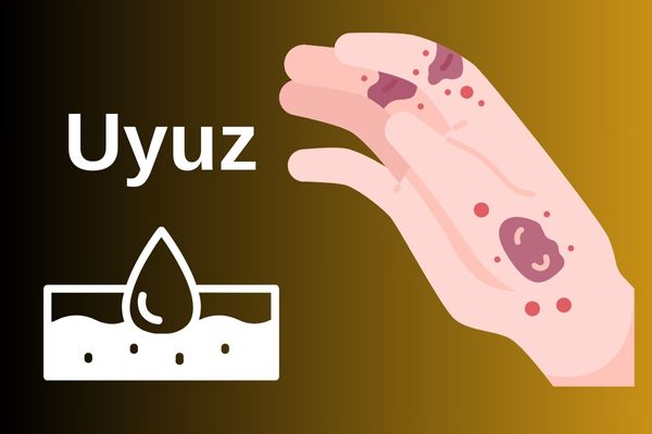 Uyuz kanda çıkar mı