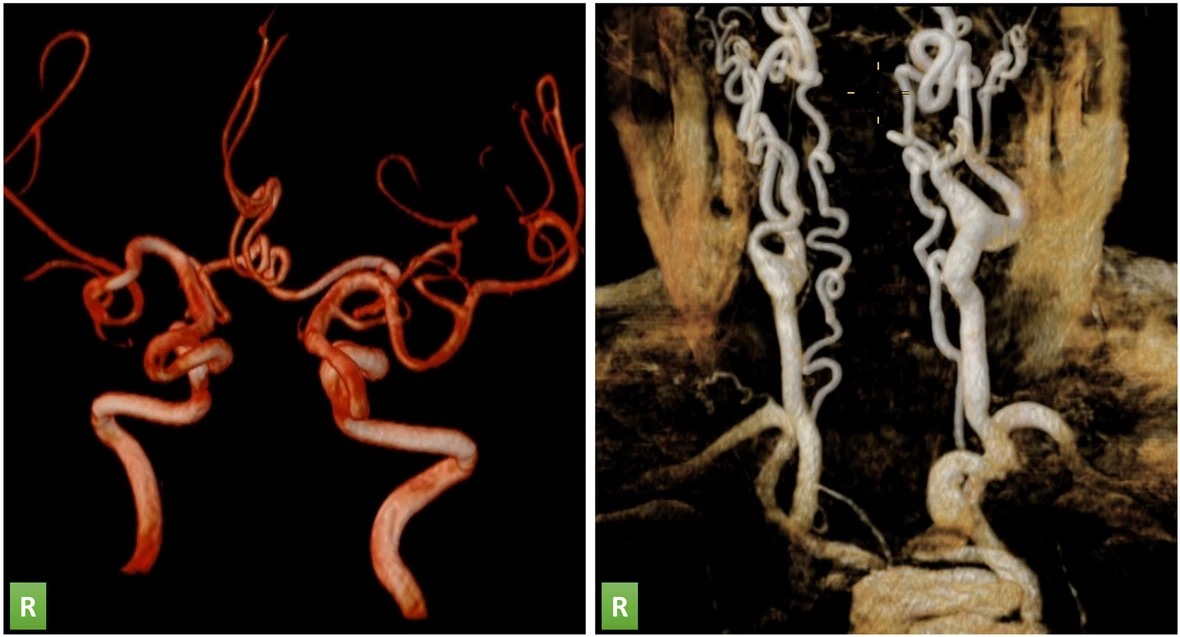 Kıvrımlı Arter Sendromu Nedir? Belirtileri ve Tedavisi kıvrımlı arter sendromu ater damar görünümü