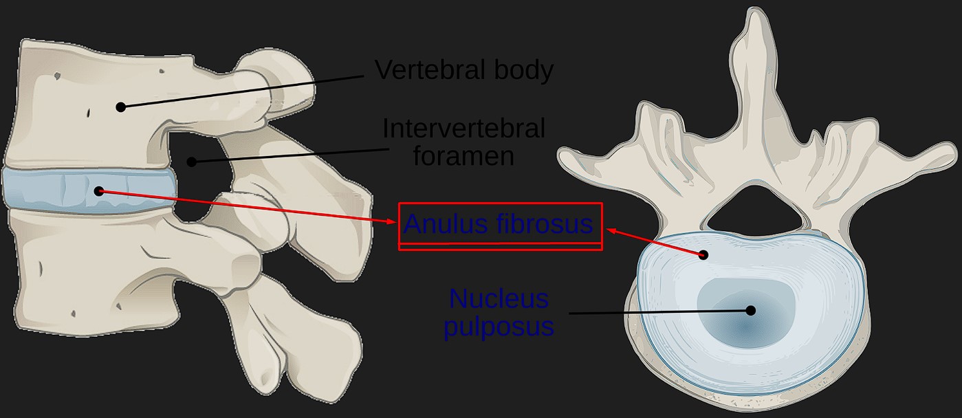 Diffüz Anüler Bulging Nedir? Sonuçlarınızı Yorumluyorum anulus fibrozis nedir
