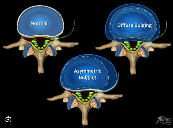 Diffüz Anüler Bulging Nedir? Sonuçlarınızı Yorumluyorum diffüz anüler bulging radyolojisi