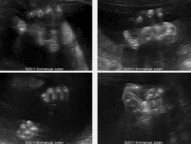gordon-sendromu-parmak-anomalisi