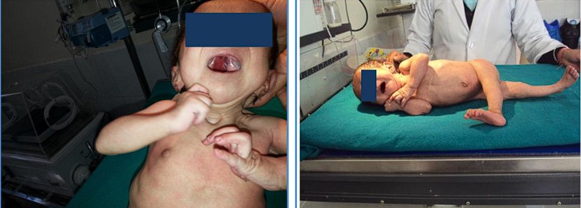 gordon sendromu tedavisi cerrahi