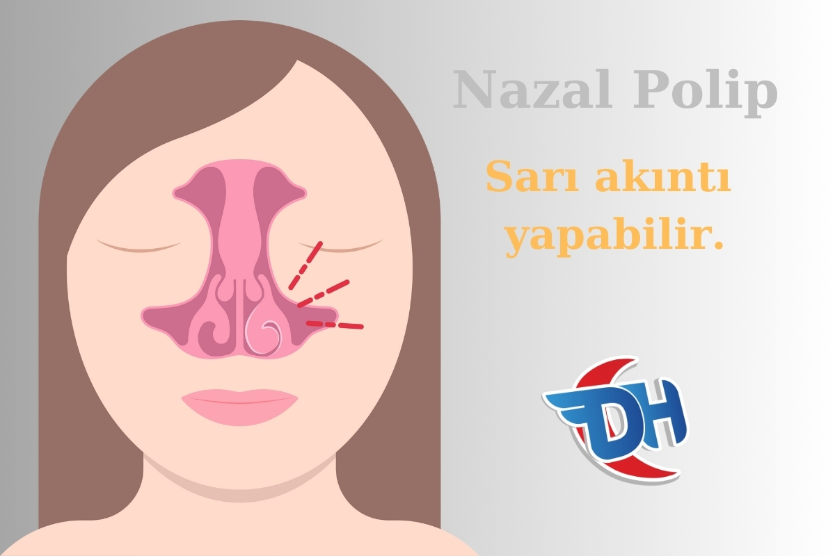 Burundan Sarı Su Gelmesi Hangi Bölüm Bakar? nazal polip sıvı akması yapabilir