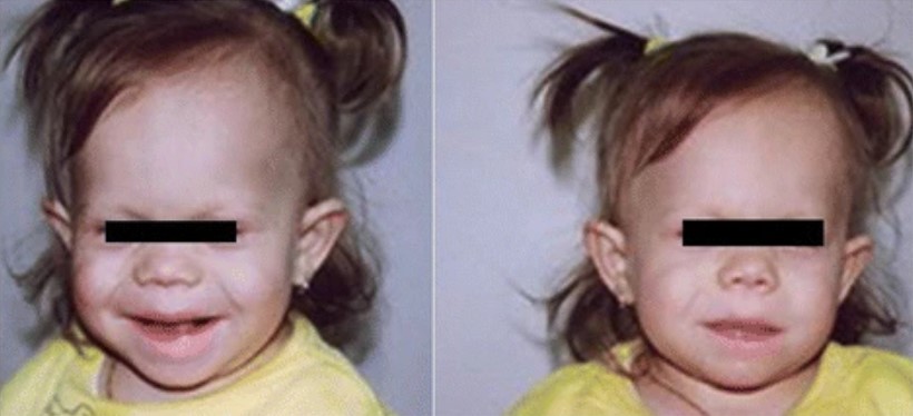 Pallister Killian Sendromu Nedir? Pallister Killian Sendromu nedir